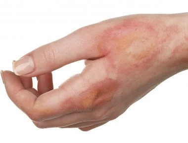 Έγκαυμα: Βήμα-βήμα η σωστή αντιμετώπιση